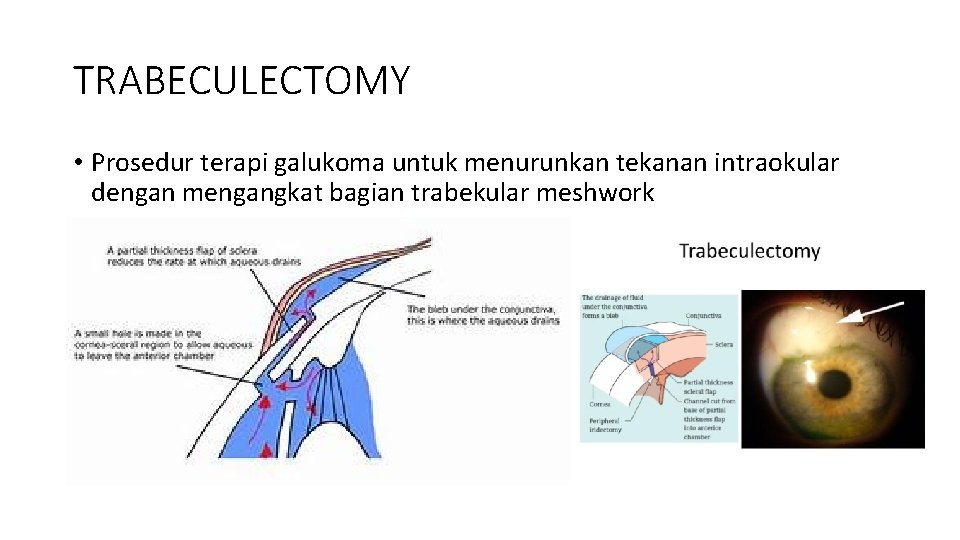 TRABECULECTOMY • Prosedur terapi galukoma untuk menurunkan tekanan intraokular dengan mengangkat bagian trabekular meshwork