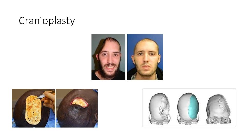 Cranioplasty 