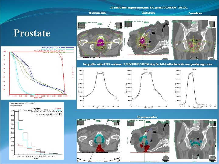 3 D Isodose line comparison (magenta TPS, green DOSIMETRY CHECK). Transverse view Sagittal view