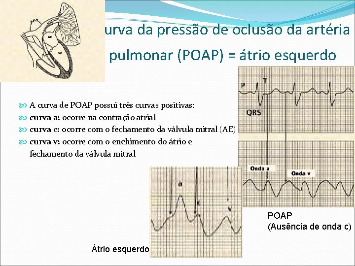 Curva da pressão de oclusão da artéria pulmonar (POAP) = átrio esquerdo A curva