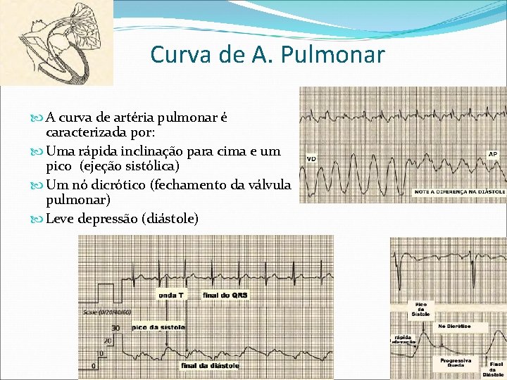 Curva de A. Pulmonar A curva de artéria pulmonar é caracterizada por: Uma rápida