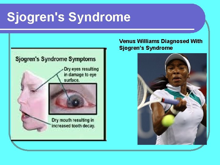 Sjogren's Syndrome Venus Williams Diagnosed With Sjogren’s Syndrome 