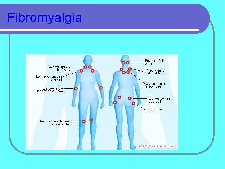 Fibromyalgia 