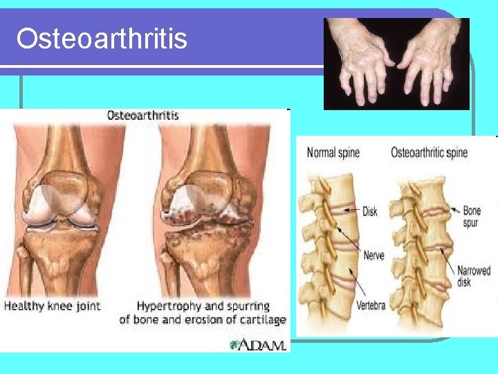 Osteoarthritis 