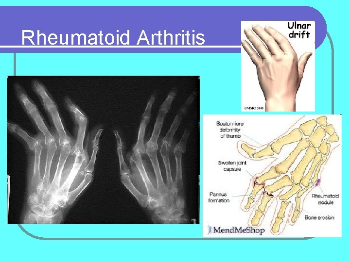 Rheumatoid Arthritis 