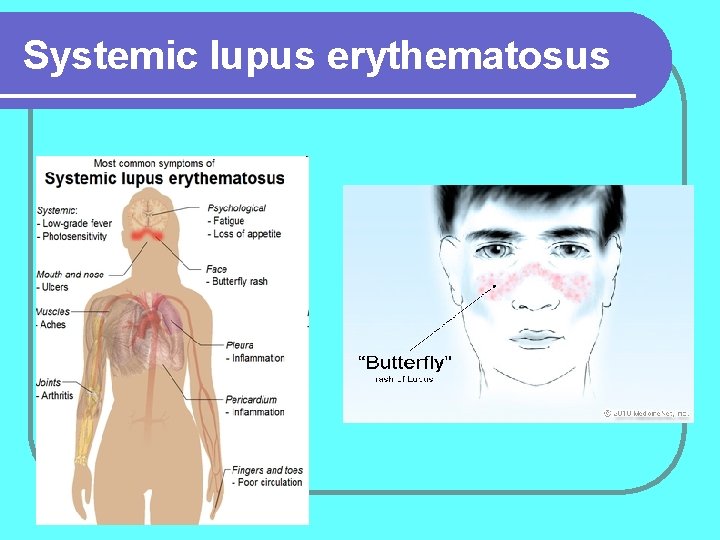 Systemic lupus erythematosus 