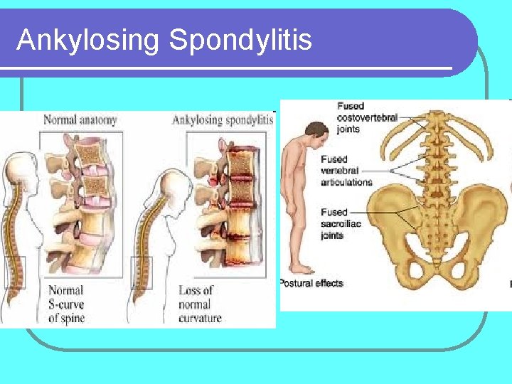 Ankylosing Spondylitis 