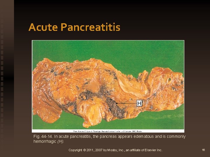 Acute Pancreatitis Fig. 44 -14. In acute pancreatitis, the pancreas appears edematous and is
