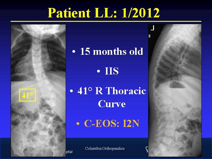 Patient LL: 1/2012 • 15 months old • IIS 41° • 41° R Thoracic