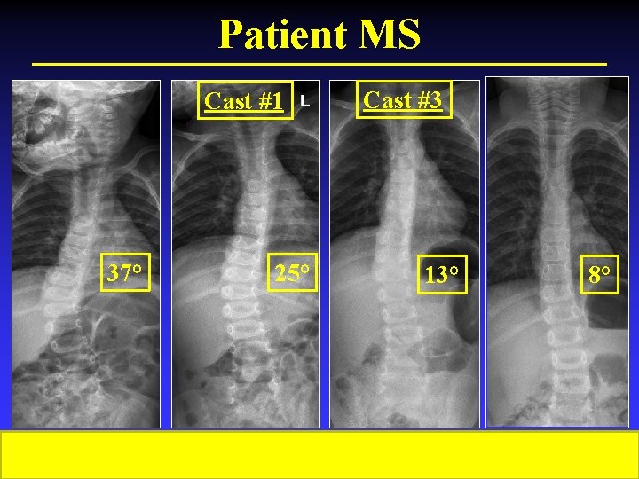 Patient MS Cast #1 37° 19 mo 25° 23 mo Cast #3 13° 28