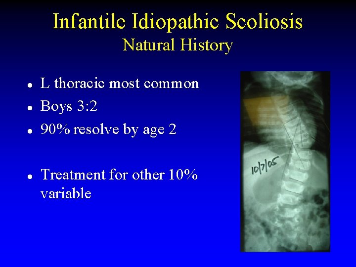 Infantile Idiopathic Scoliosis Natural History l l L thoracic most common Boys 3: 2