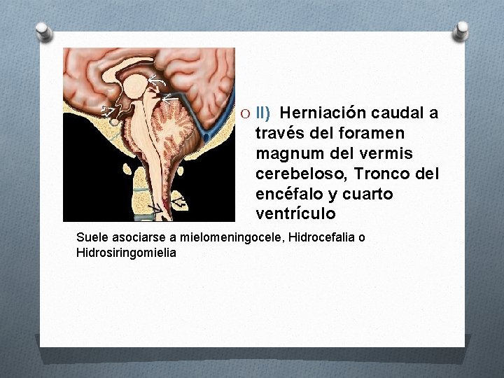 O II) Herniación caudal a través del foramen magnum del vermis cerebeloso, Tronco del