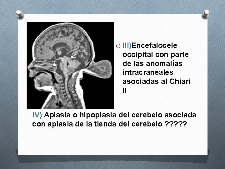 O III)Encefalocele occipital con parte de las anomalías intracraneales asociadas al Chiari II IV)