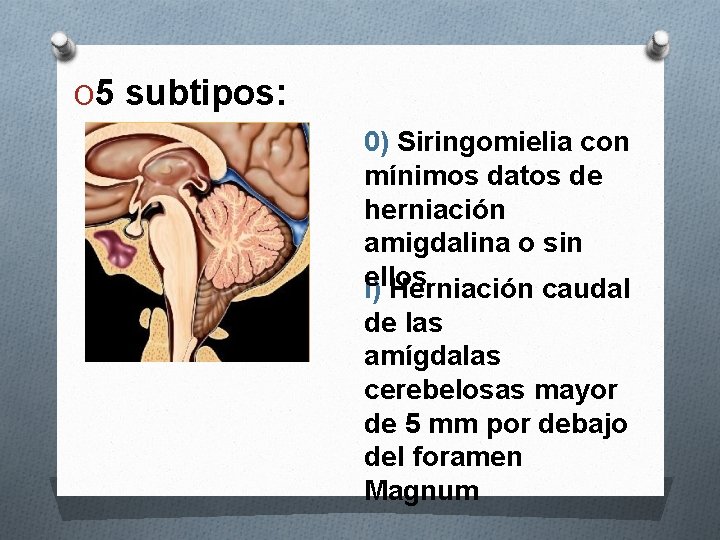 O 5 subtipos: 0) Siringomielia con mínimos datos de herniación amigdalina o sin ellos
