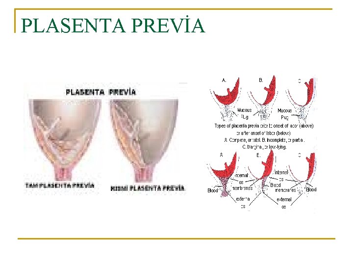PLASENTA PREVİA 