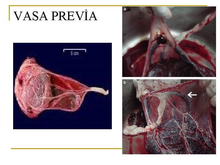 VASA PREVİA 
