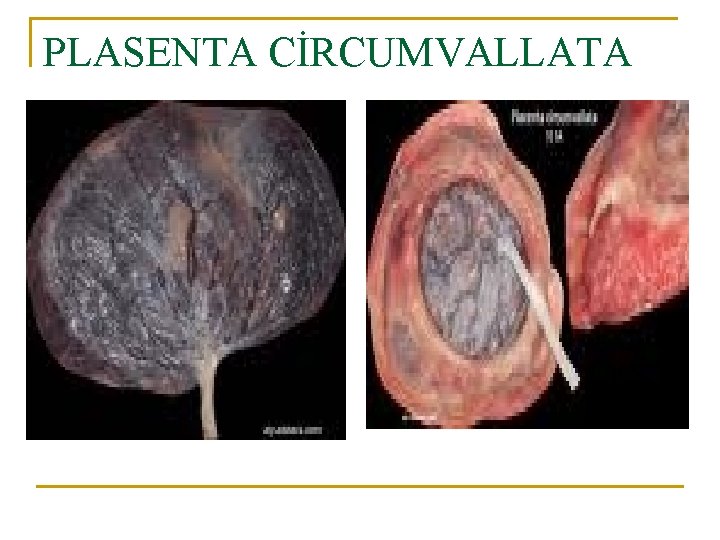 PLASENTA CİRCUMVALLATA 