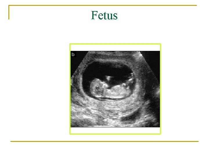 Fetus 