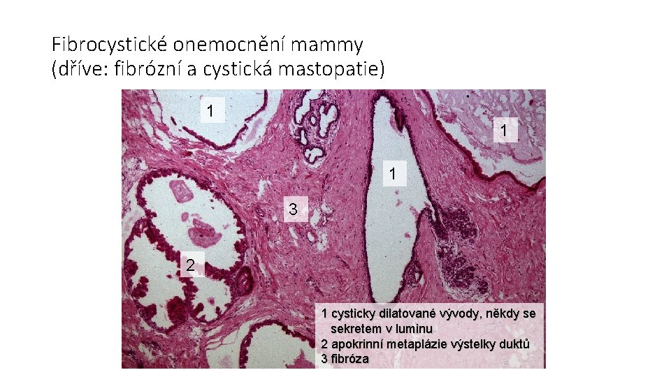 Fibrocystické onemocnění mammy (dříve: fibrózní a cystická mastopatie) 1 1 1 3 2 1