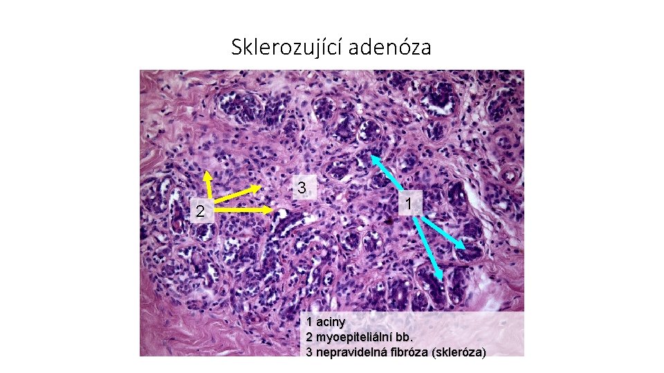 Sklerozující adenóza 3 2 1 1 aciny 2 myoepiteliální bb. 3 nepravidelná fibróza (skleróza)