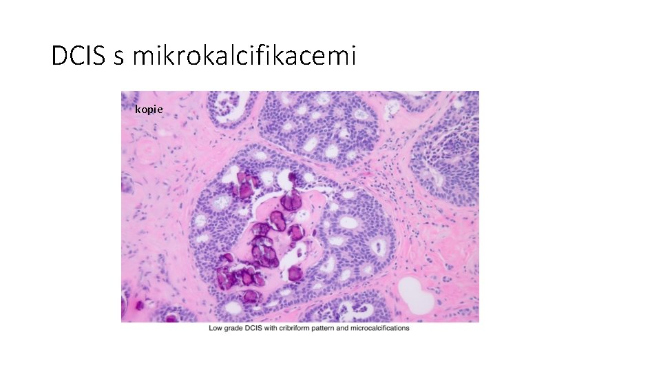 DCIS s mikrokalcifikacemi kopie 