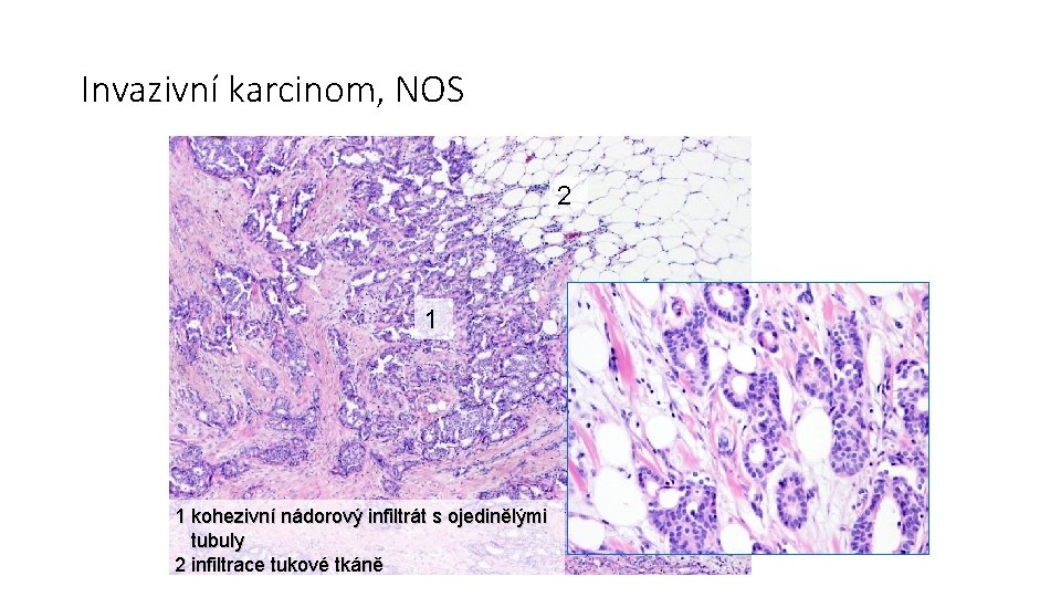 Invazivní karcinom, NOS 2 1 1 kohezivní nádorový infiltrát s ojedinělými tubuly 2 infiltrace