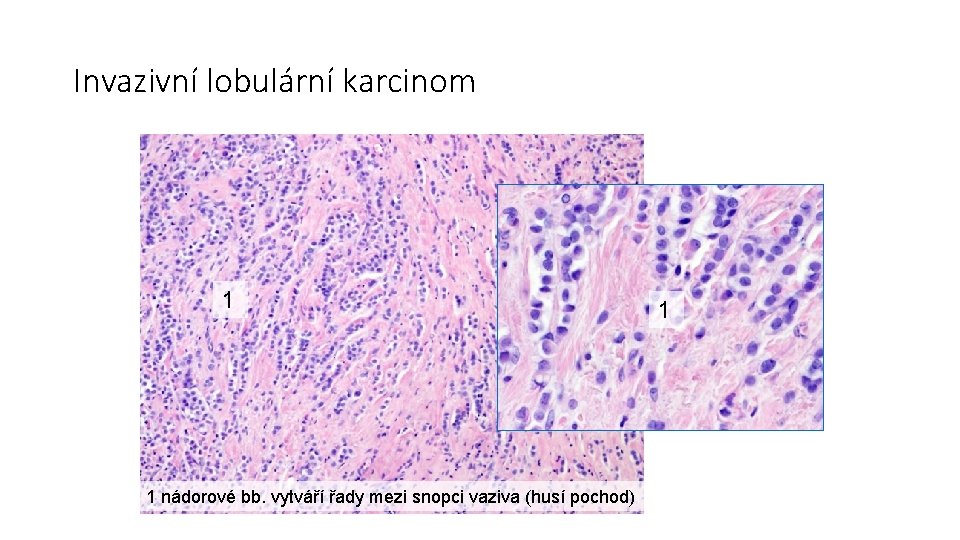 Invazivní lobulární karcinom 1 1 nádorové bb. vytváří řady mezi snopci vaziva (husí pochod)