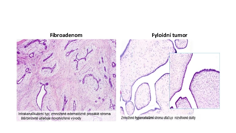 Fibroadenom Fyloidní tumor 