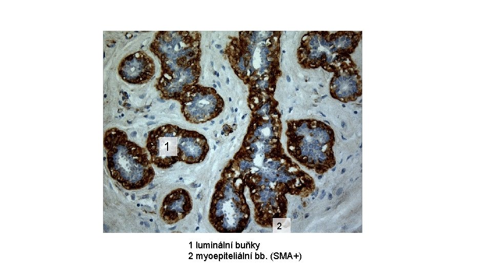 1 2 1 luminální buňky 2 myoepiteliální bb. (SMA+) 