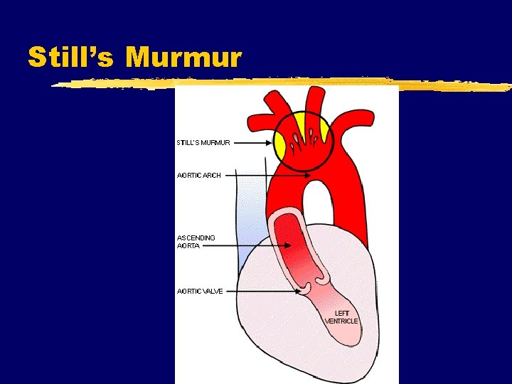 Still’s Murmur 