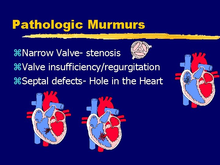 Pathologic Murmurs z. Narrow Valve- stenosis z. Valve insufficiency/regurgitation z. Septal defects- Hole in