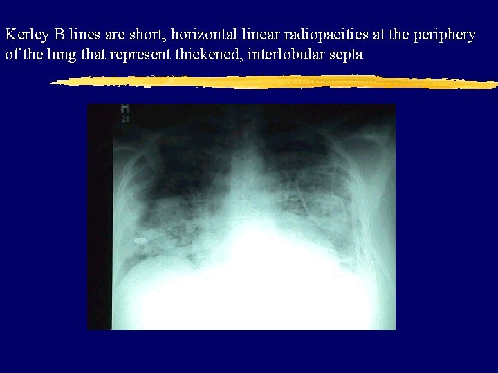 Kerley B lines are short, horizontal linear radiopacities at the periphery of the lung