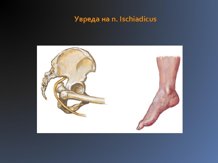 Увреда на n. Ischiadicus 