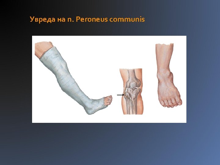 Увреда на n. Peroneus communis 