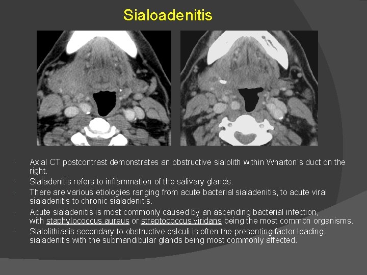 Sialoadenitis Axial CT postcontrast demonstrates an obstructive sialolith within Wharton’s duct on the right.
