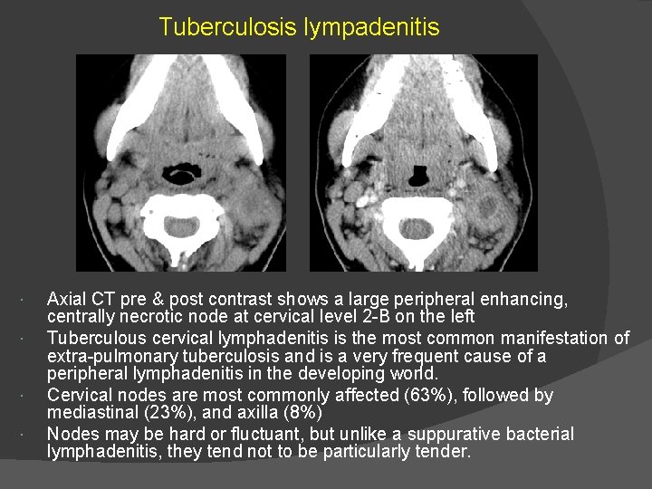 Tuberculosis lympadenitis Axial CT pre & post contrast shows a large peripheral enhancing, centrally