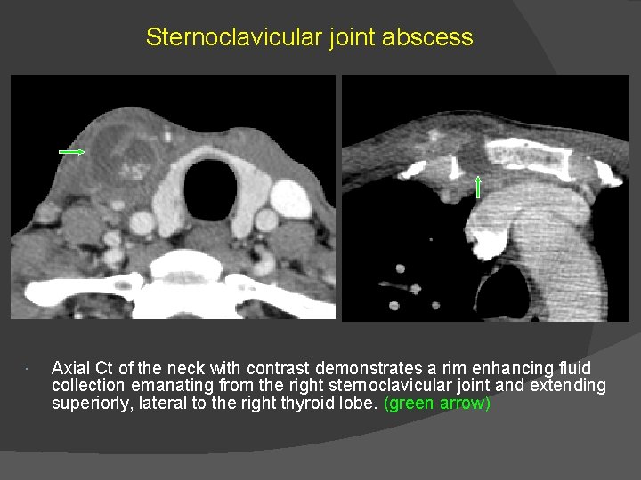 Sternoclavicular joint abscess Axial Ct of the neck with contrast demonstrates a rim enhancing