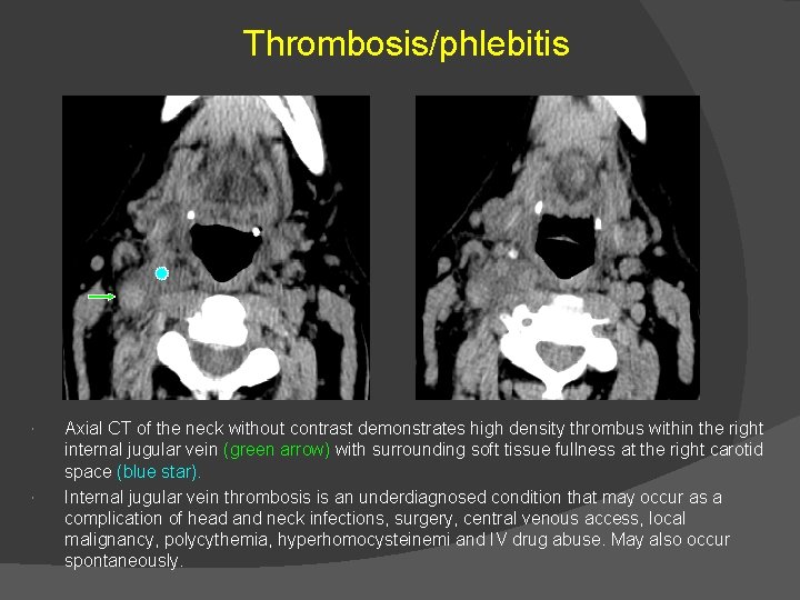Thrombosis/phlebitis Axial CT of the neck without contrast demonstrates high density thrombus within the