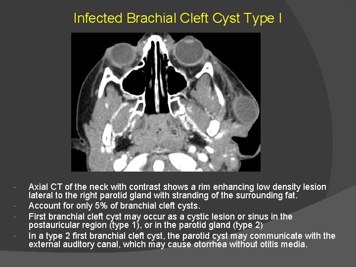 Infected Brachial Cleft Cyst Type I Axial CT of the neck with contrast shows