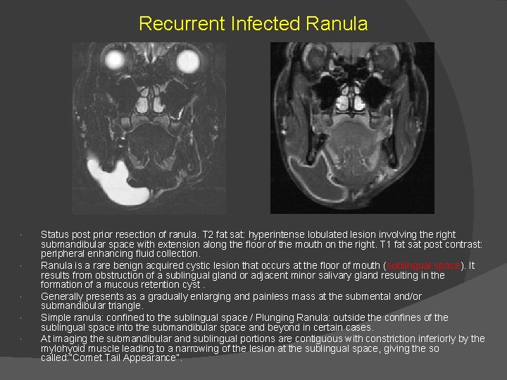 Recurrent Infected Ranula Status post prior resection of ranula. T 2 fat sat: hyperintense