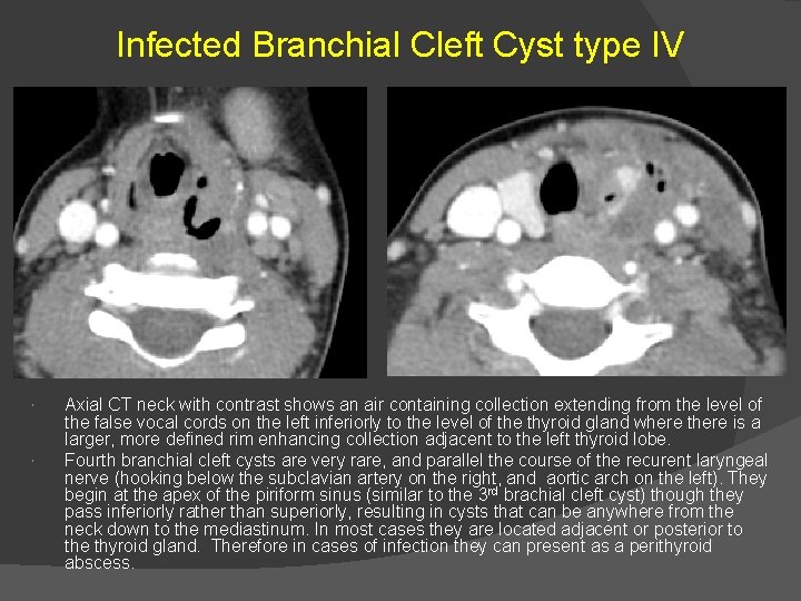 Infected Branchial Cleft Cyst type IV Axial CT neck with contrast shows an air