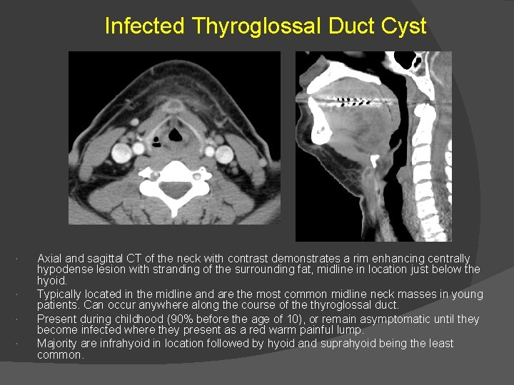 Infected Thyroglossal Duct Cyst Axial and sagittal CT of the neck with contrast demonstrates