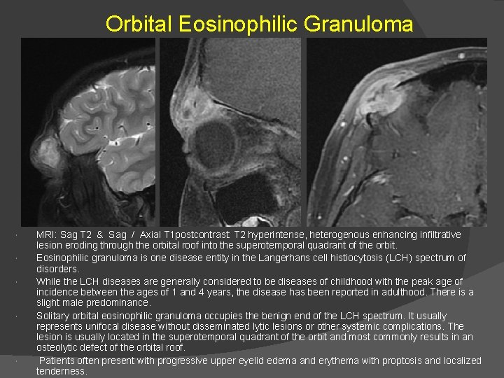 Orbital Eosinophilic Granuloma MRI: Sag T 2 & Sag / Axial T 1 postcontrast: