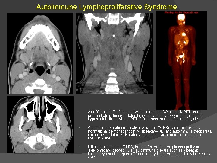 Autoimmune Lymphoproliferative Syndrome Axial/Coronal CT of the neck with contrast and Whole body PET