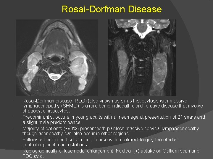 Rosai-Dorfman Disease Rosai-Dorfman disease (RDD) (also known as sinus histiocytosis with massive lymphadenopathy (SHML))
