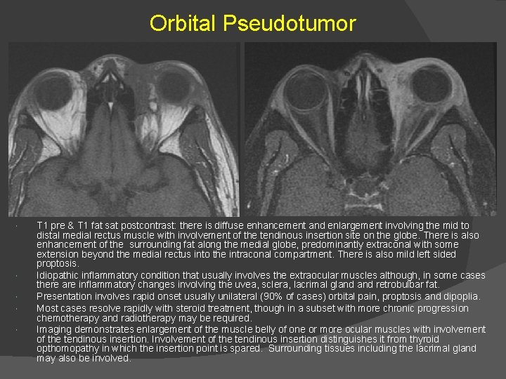 Orbital Pseudotumor T 1 pre & T 1 fat sat postcontrast: there is diffuse