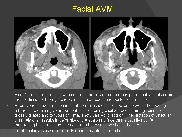 Facial AVM Axial CT of the maxofacial with contrast demonstrate numerous prominent vessels within