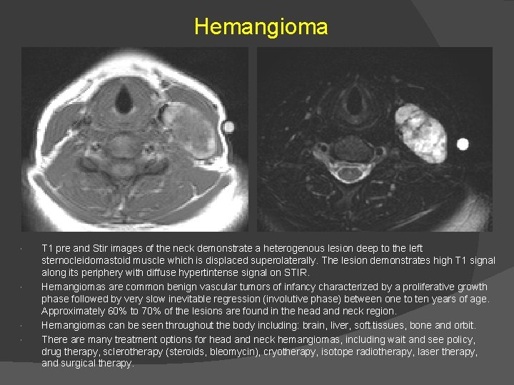 Hemangioma T 1 pre and Stir images of the neck demonstrate a heterogenous lesion
