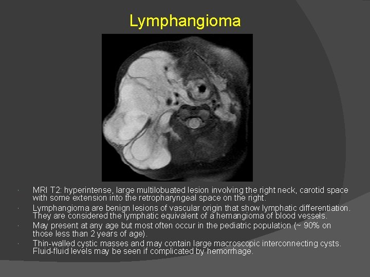 Lymphangioma MRI T 2: hyperintense, large multilobuated lesion involving the right neck, carotid space