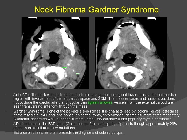 Neck Fibroma Gardner Syndrome Axial CT of the neck with contrast demonstrates a large